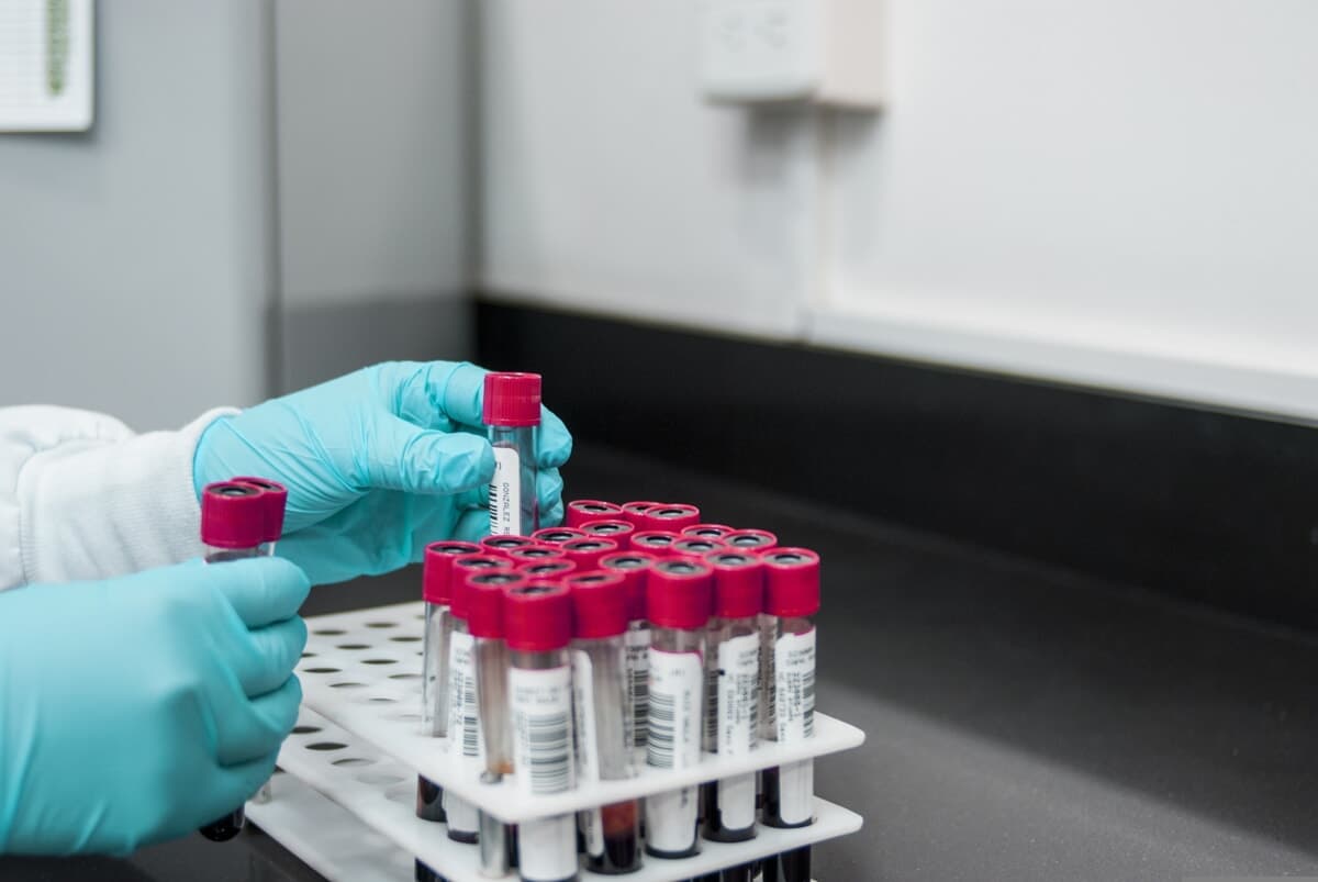 Epatite A, casi in aumento nel Lazio, lo Spallanzani: Focolai legati al consumo di cibi contaminati"