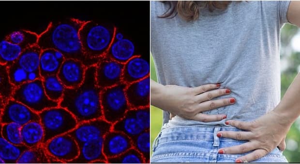  Tumore pancreas, come capire se il mal di schiena è un sintomo. L'oncologo: «Ecco quali sono i segnali da considerare» 